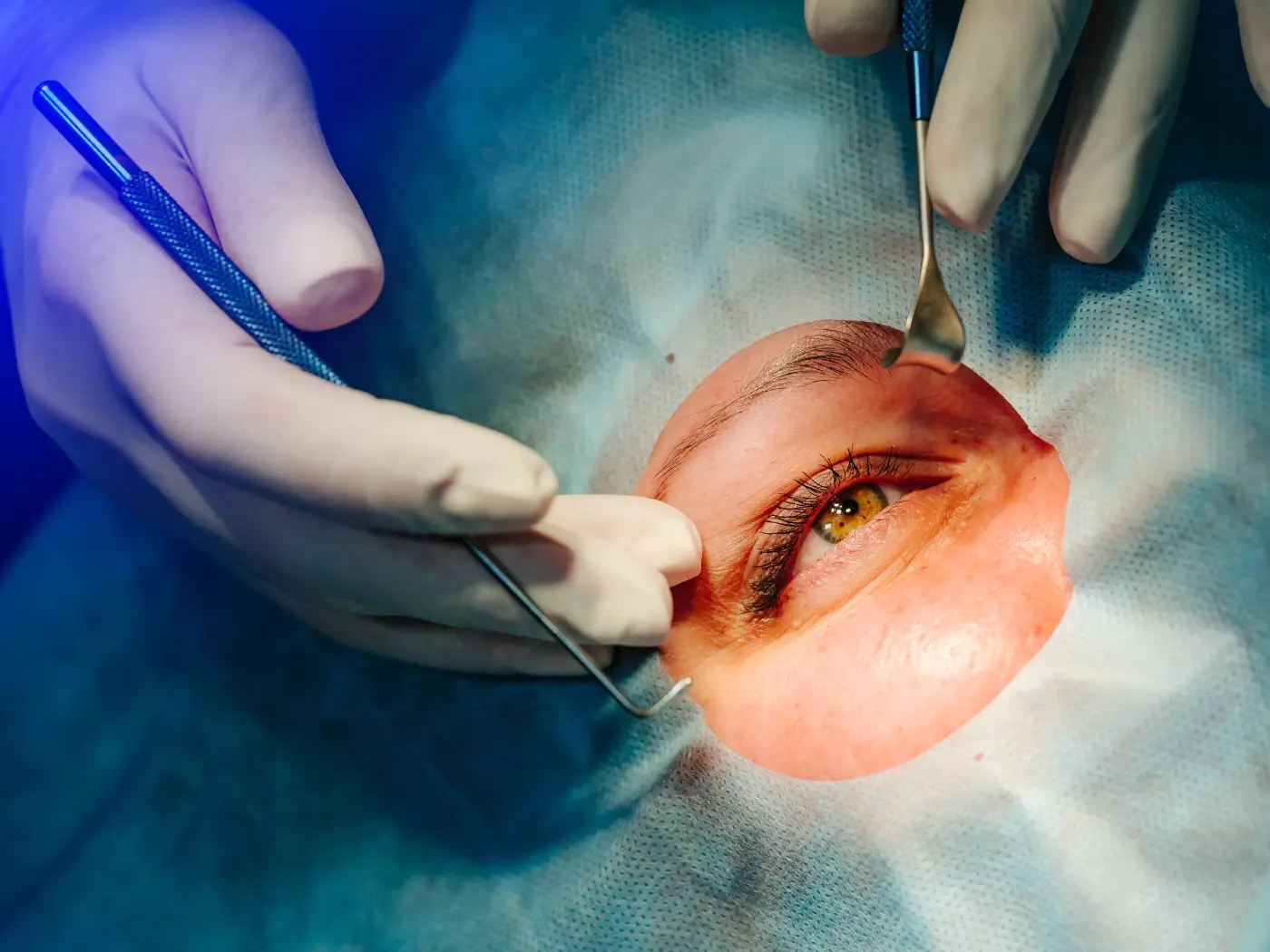 Plastic surgery | Experiences with Eyelid Surgery