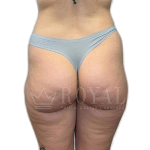 Естетска хирургија | Пре и после