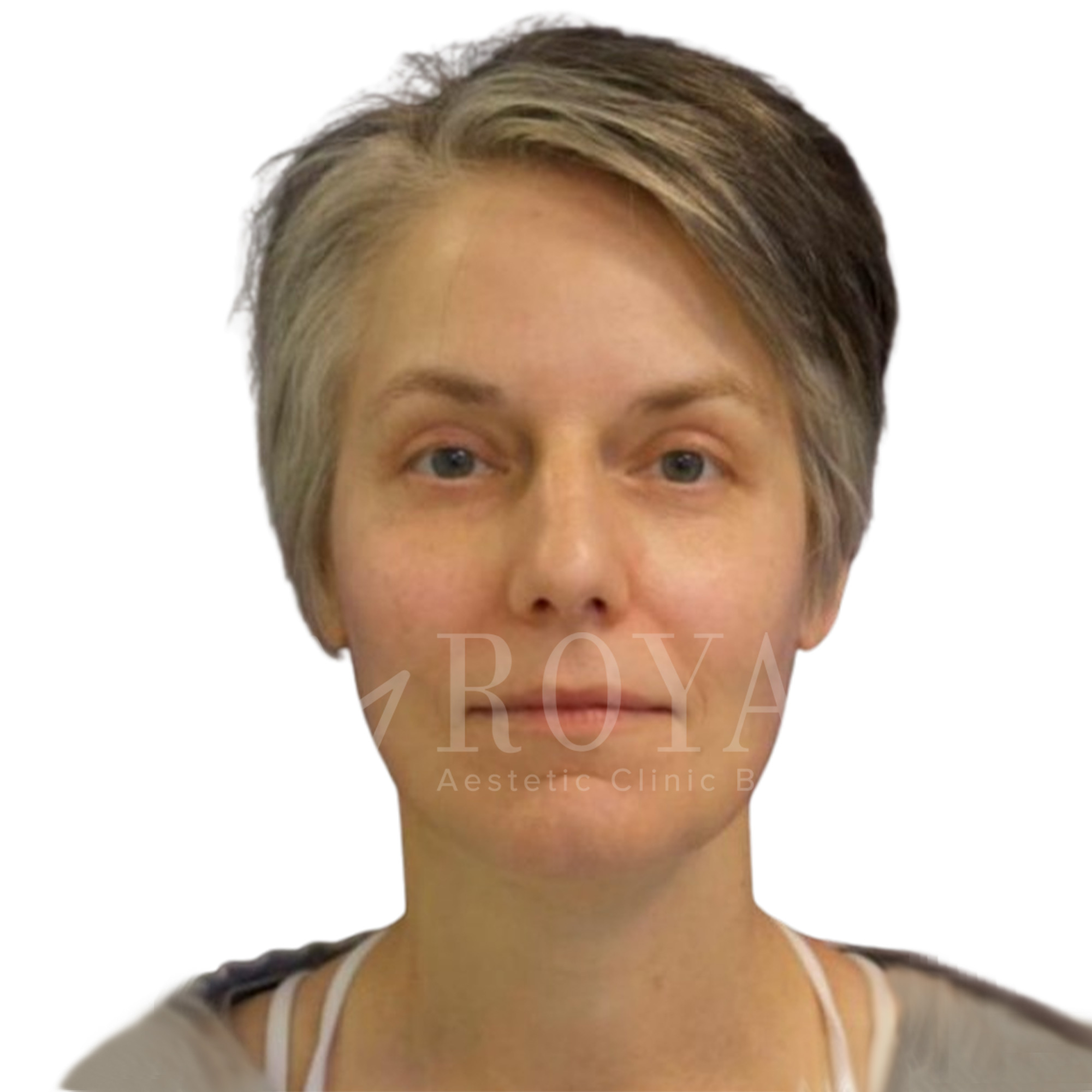Estetska hirurgija | Pre i posle