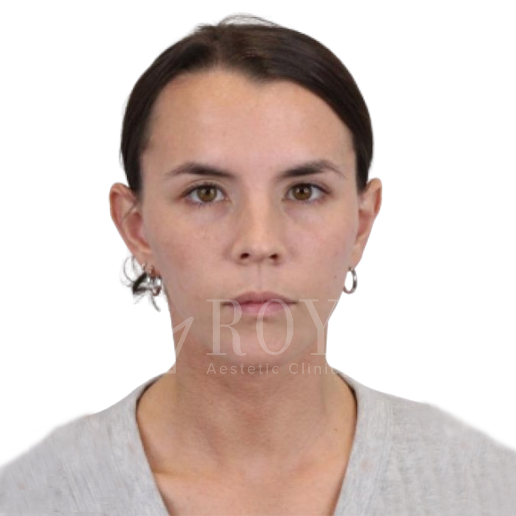 Estetska hirurgija | Pre i posle