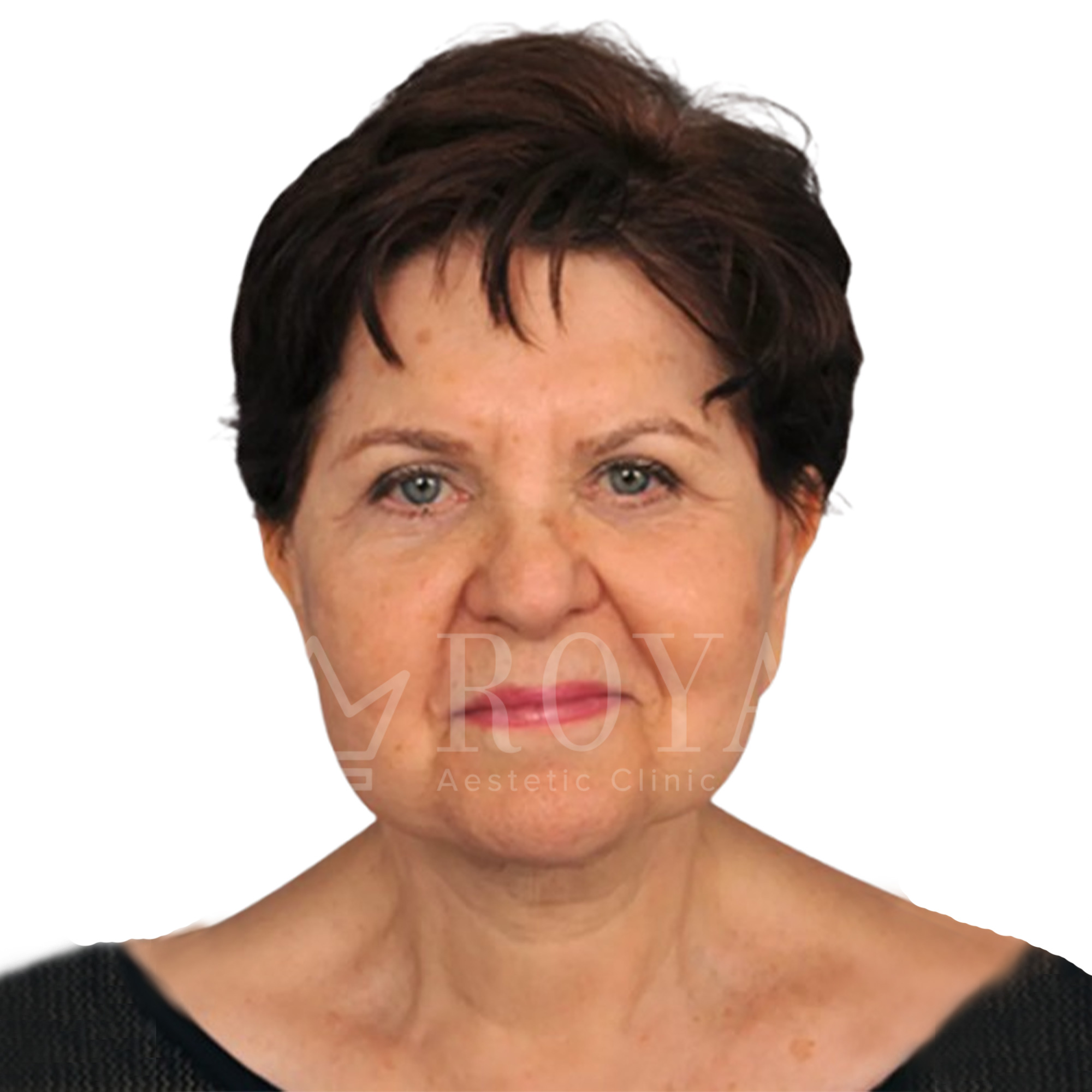 Estetska hirurgija | Pre i posle