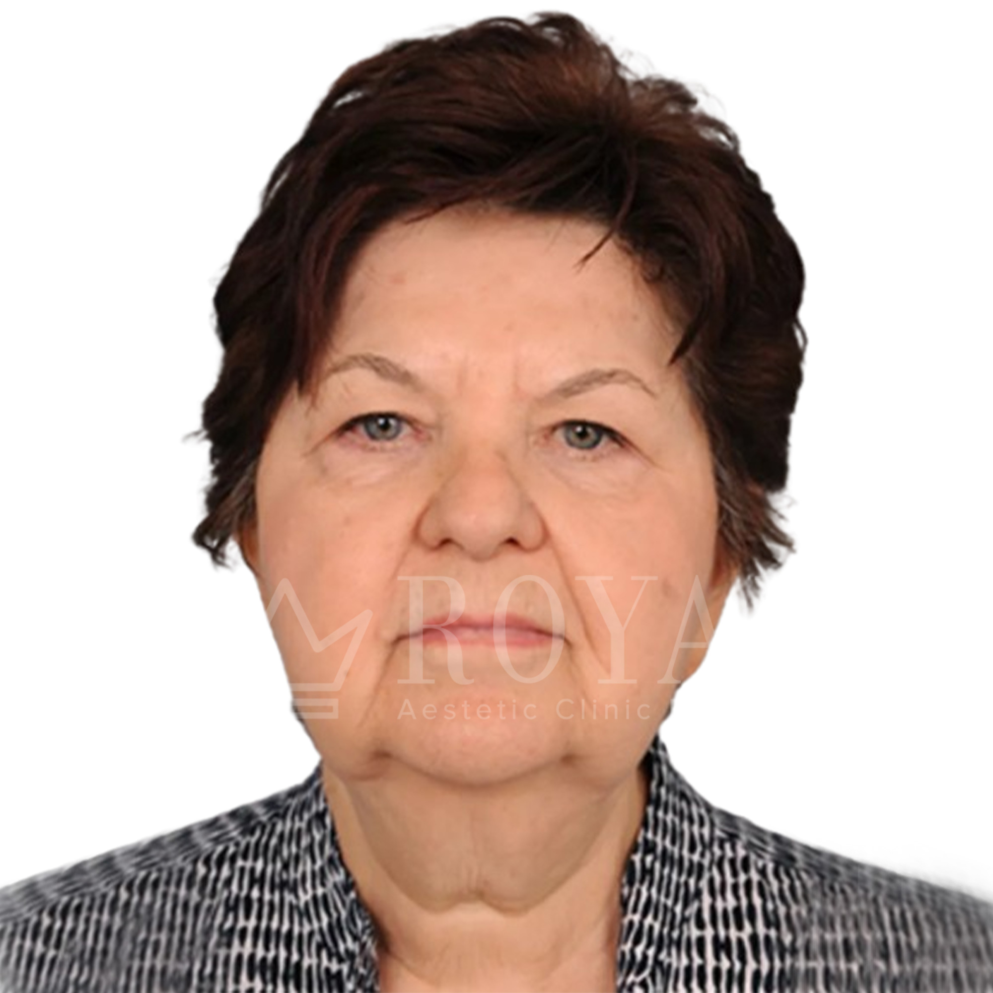 Estetska hirurgija | Pre i posle