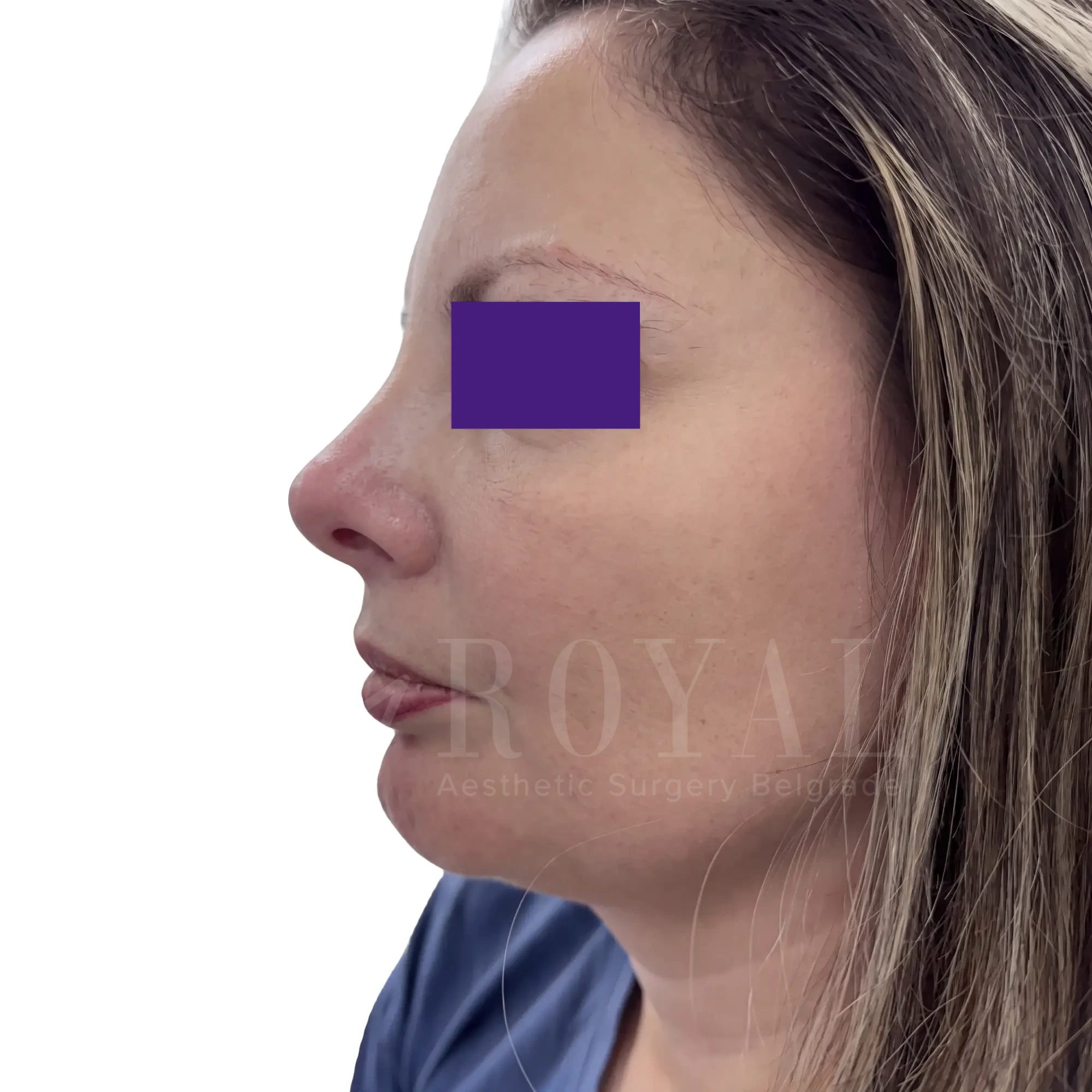 Plastic surgery | Nose surgery 13