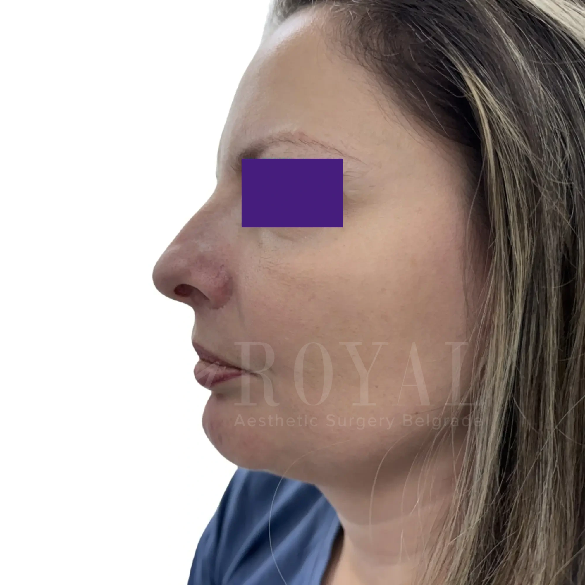 Plastic surgery | Nose surgery 13