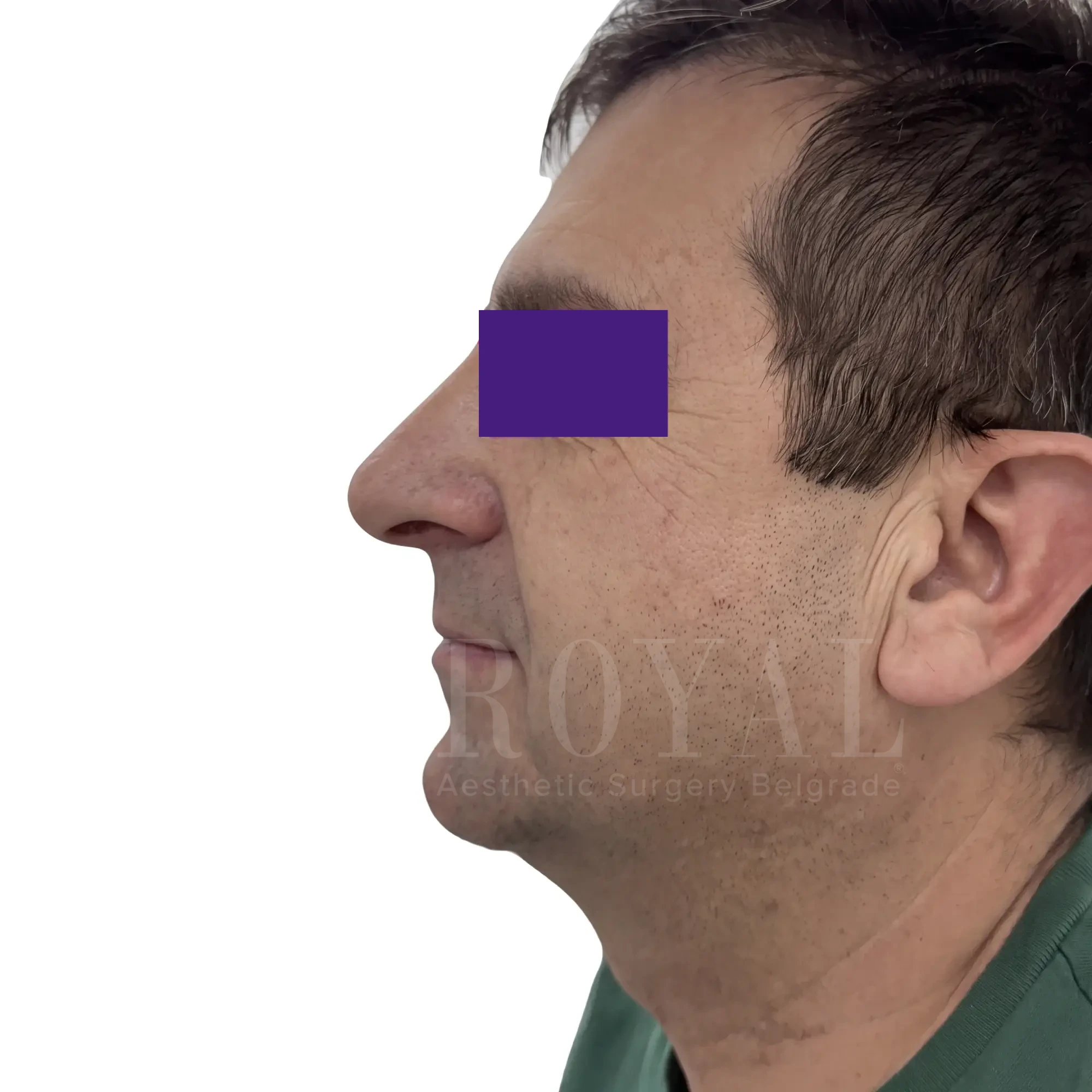 Plastic surgery | Nose surgery 14