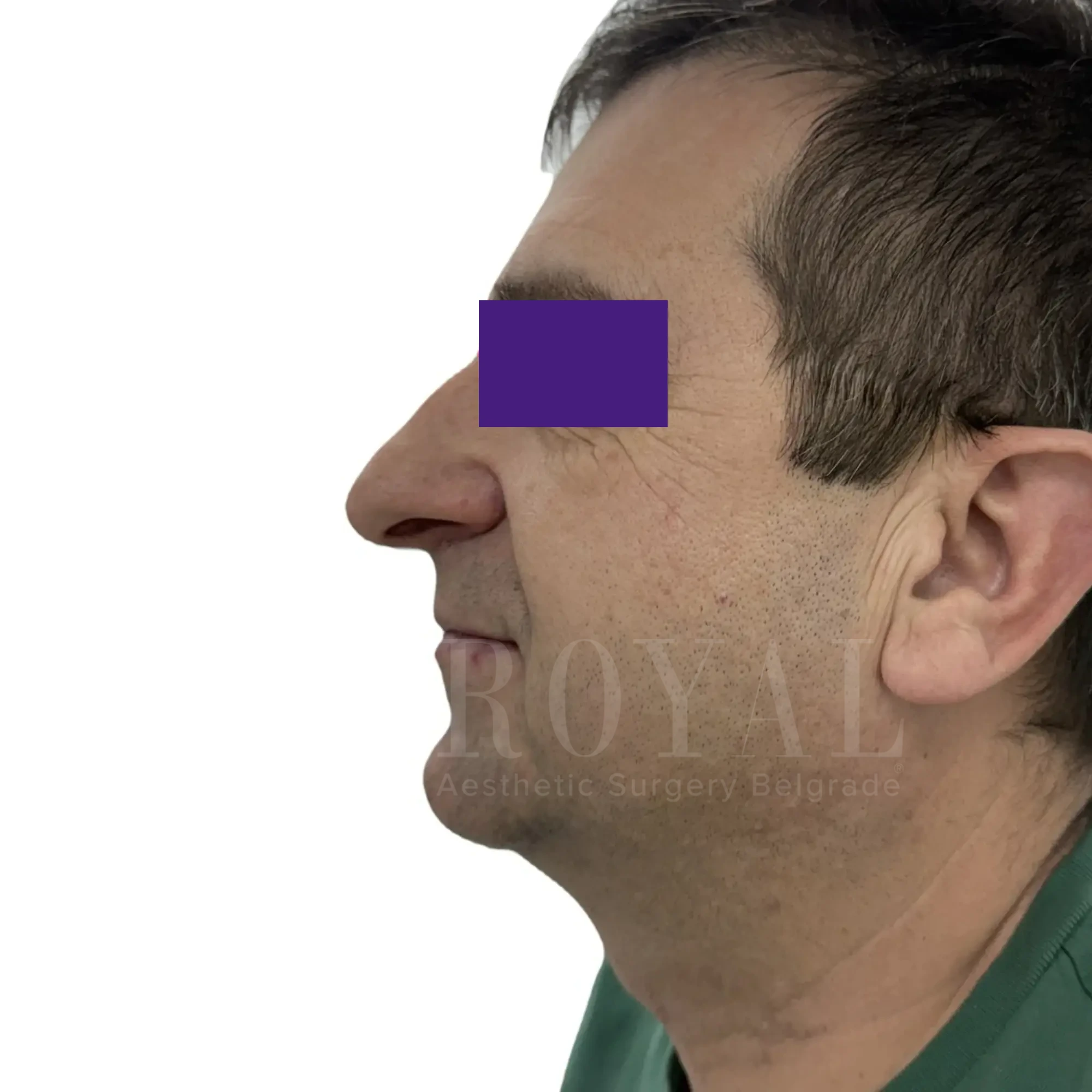 Plastic surgery | Nose surgery 14