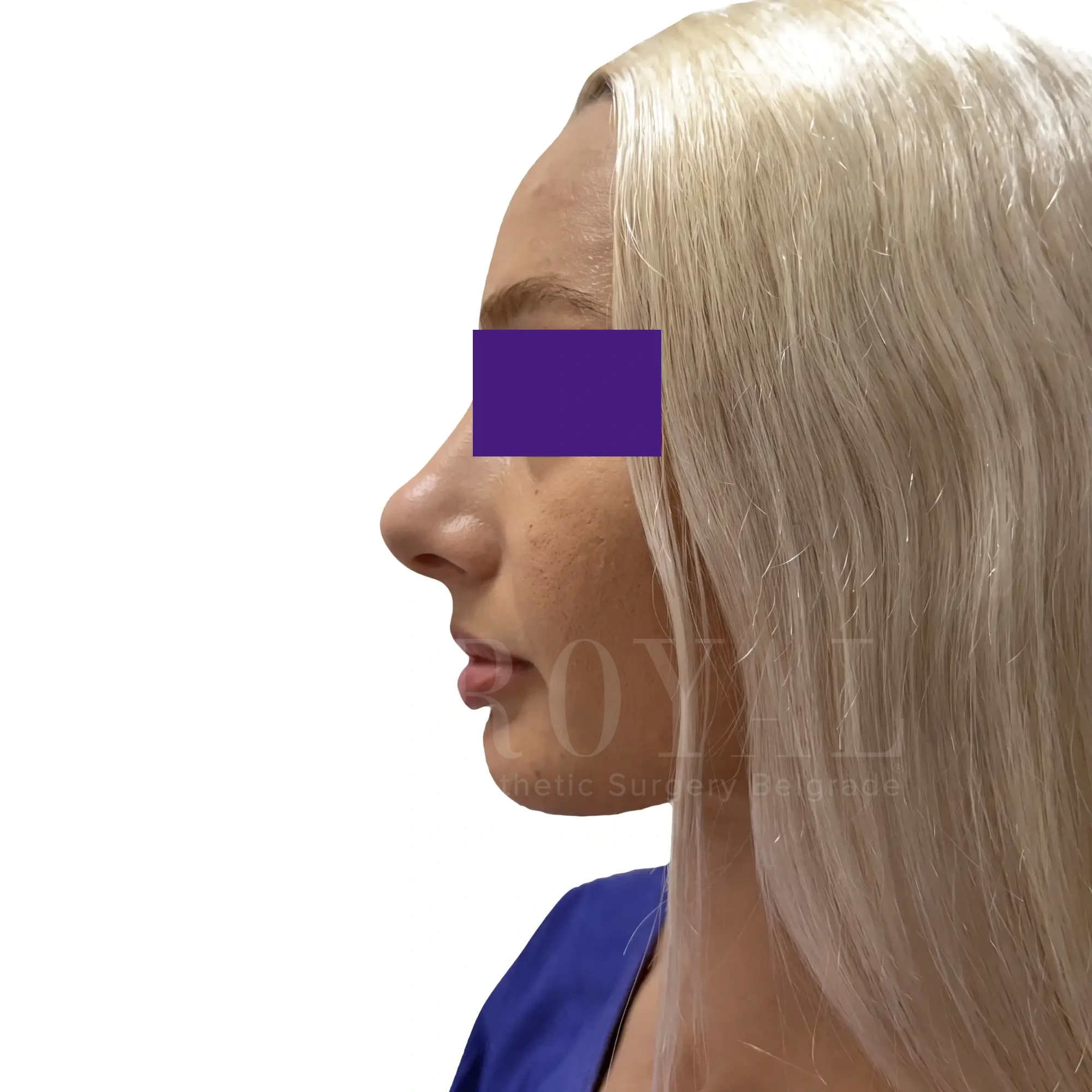 Plastic surgery | Nose surgery 16