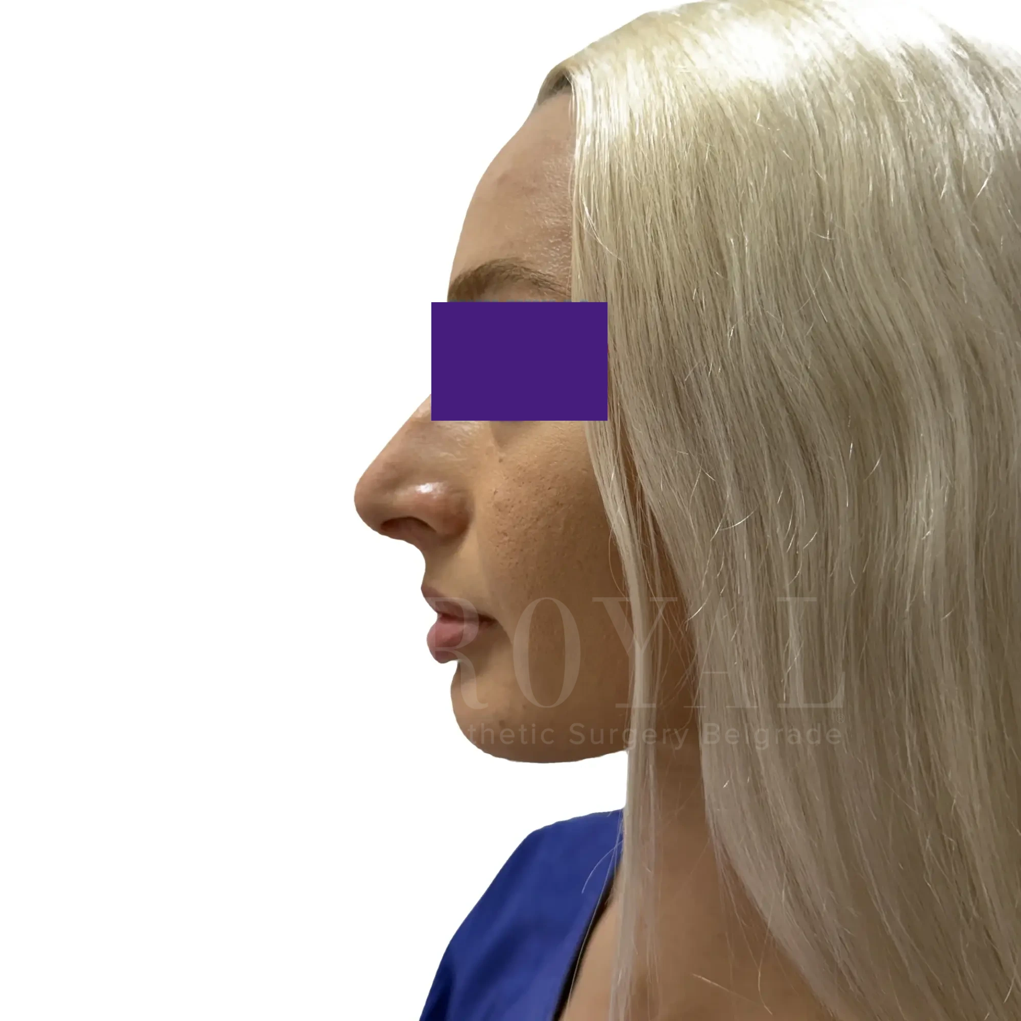 Plastic surgery | Nose surgery 16