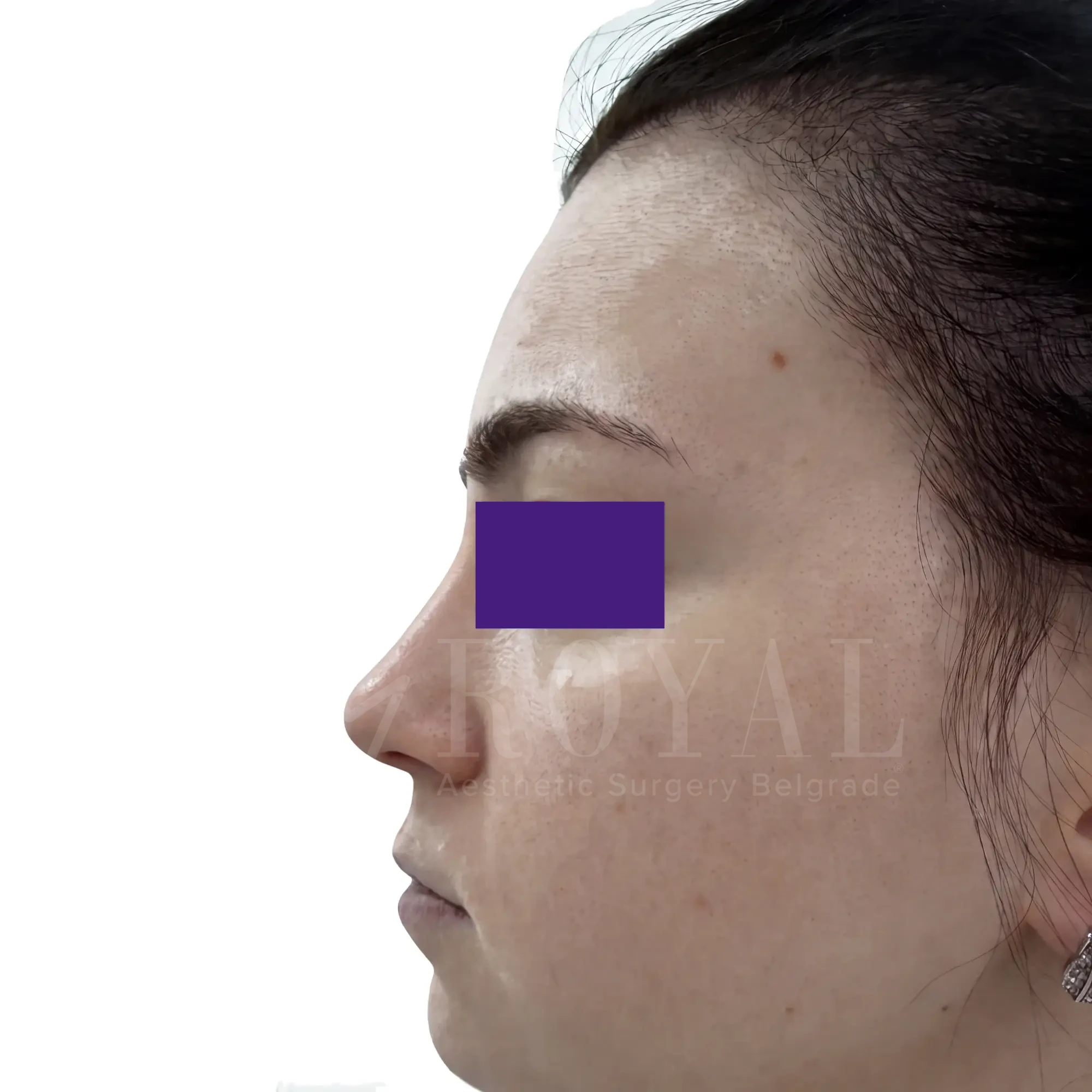 Plastic surgery | Nose surgery 17