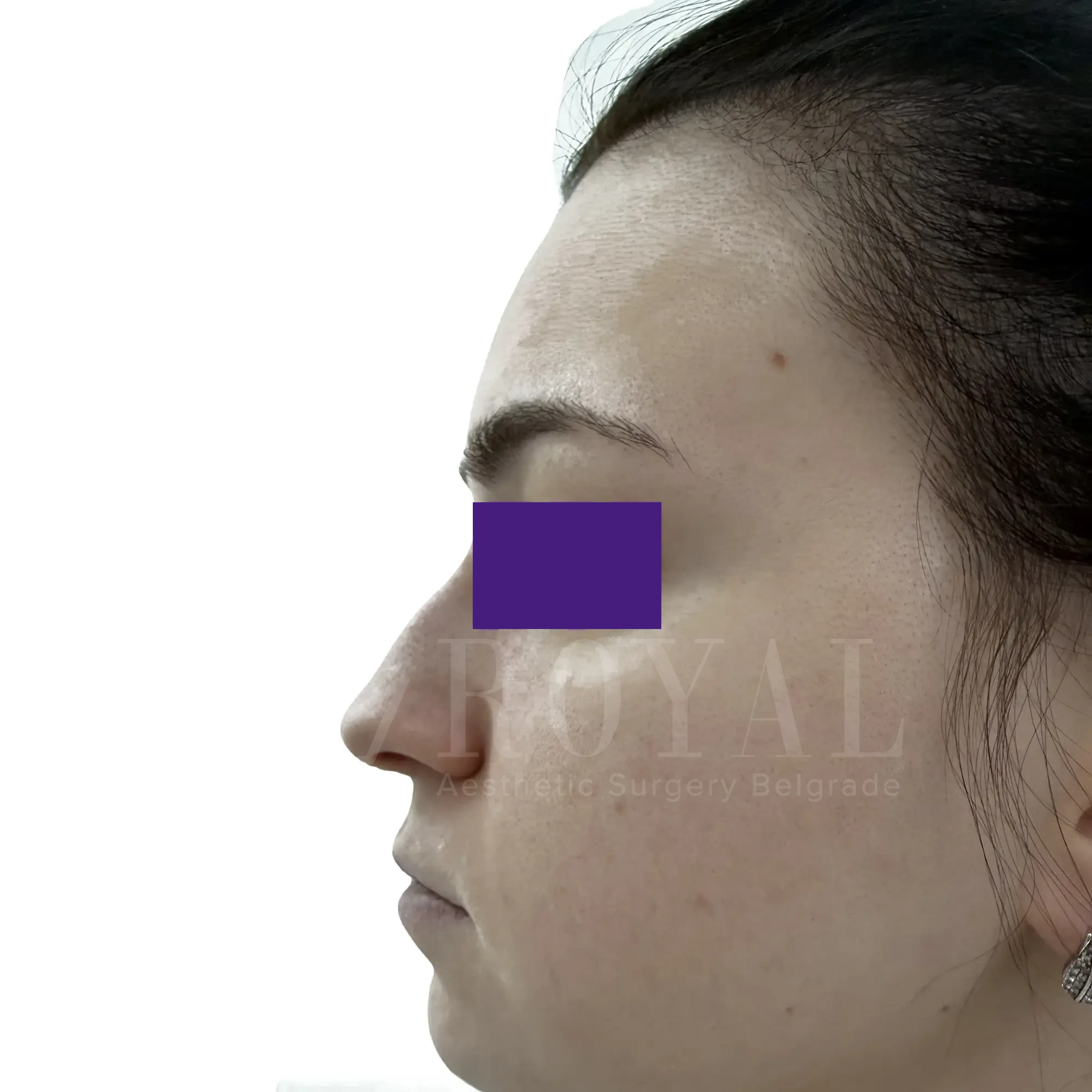 Plastic surgery | Nose surgery 17