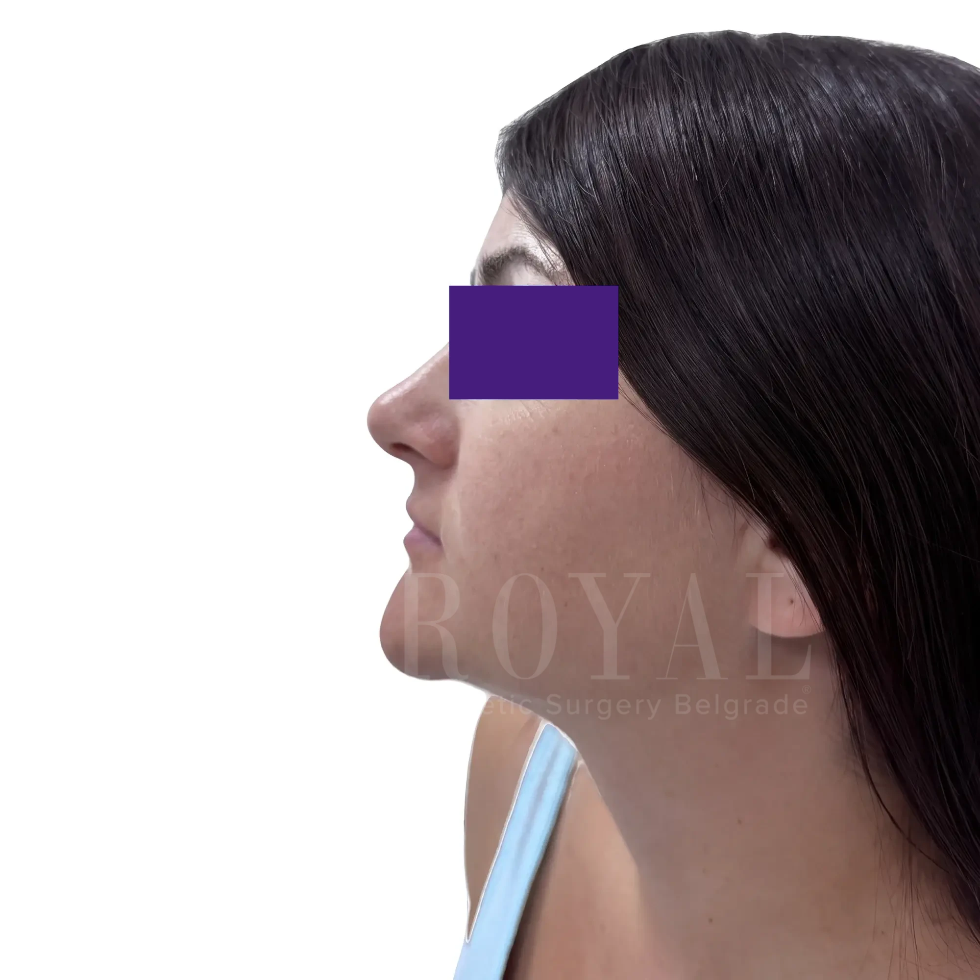 Plastic surgery | Nose surgery 18