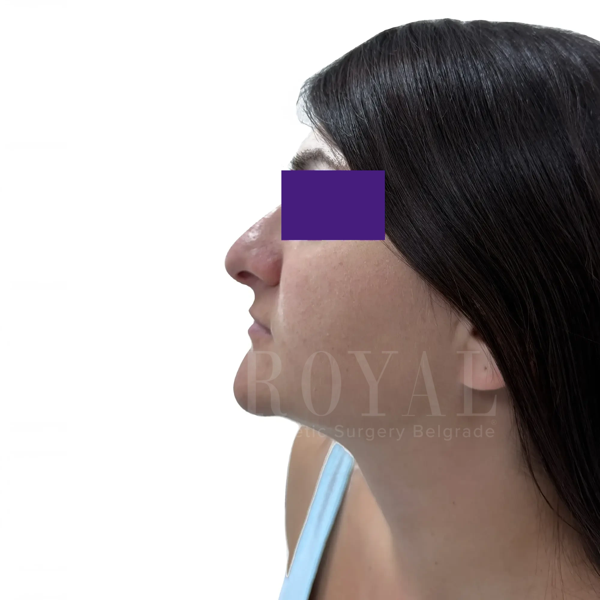 Plastic surgery | Nose surgery 18