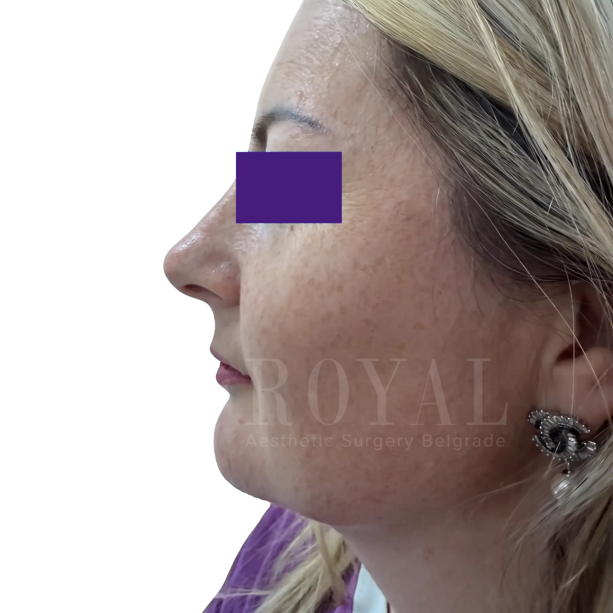 Plastic surgery | Nose surgery 19