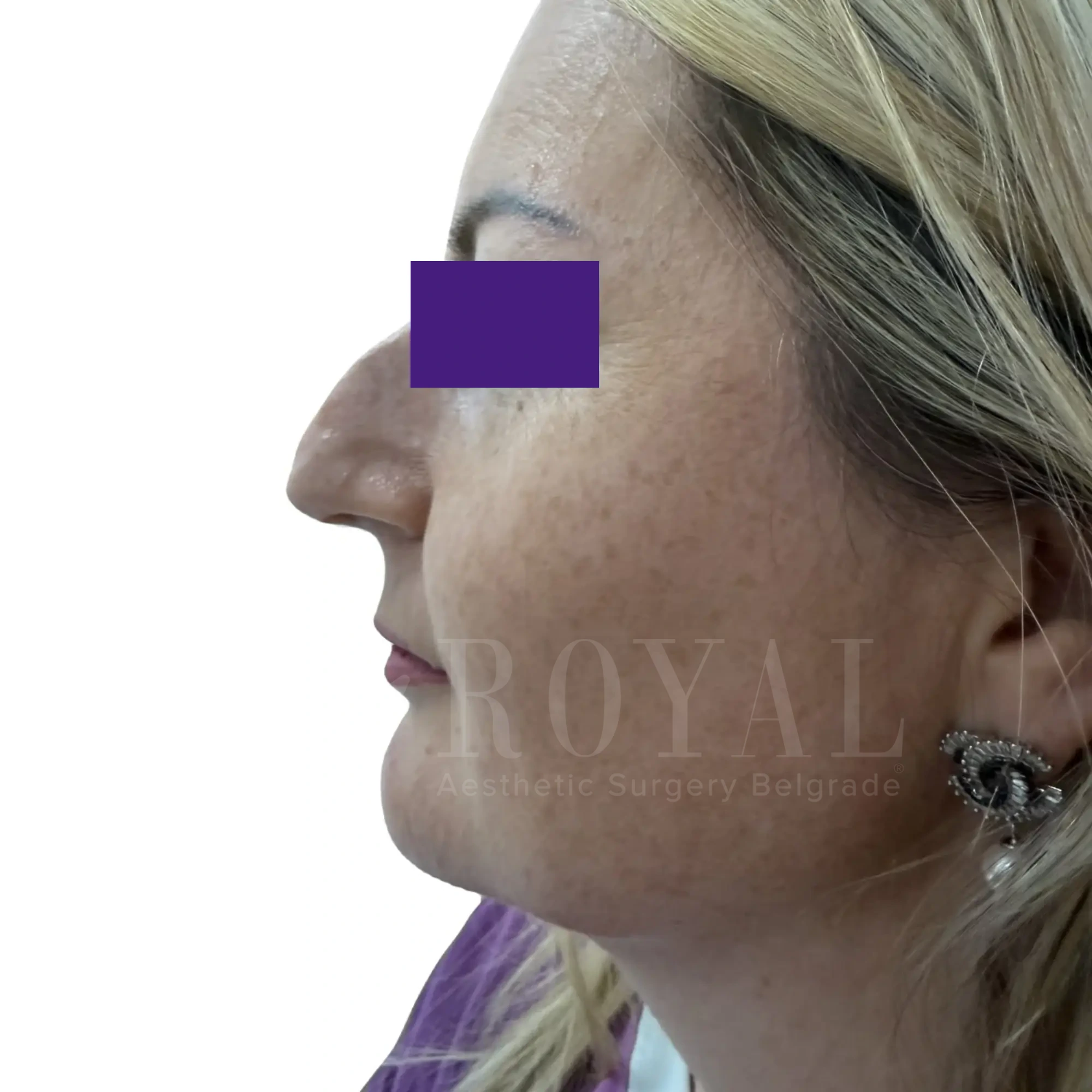 Plastic surgery | Nose surgery 19