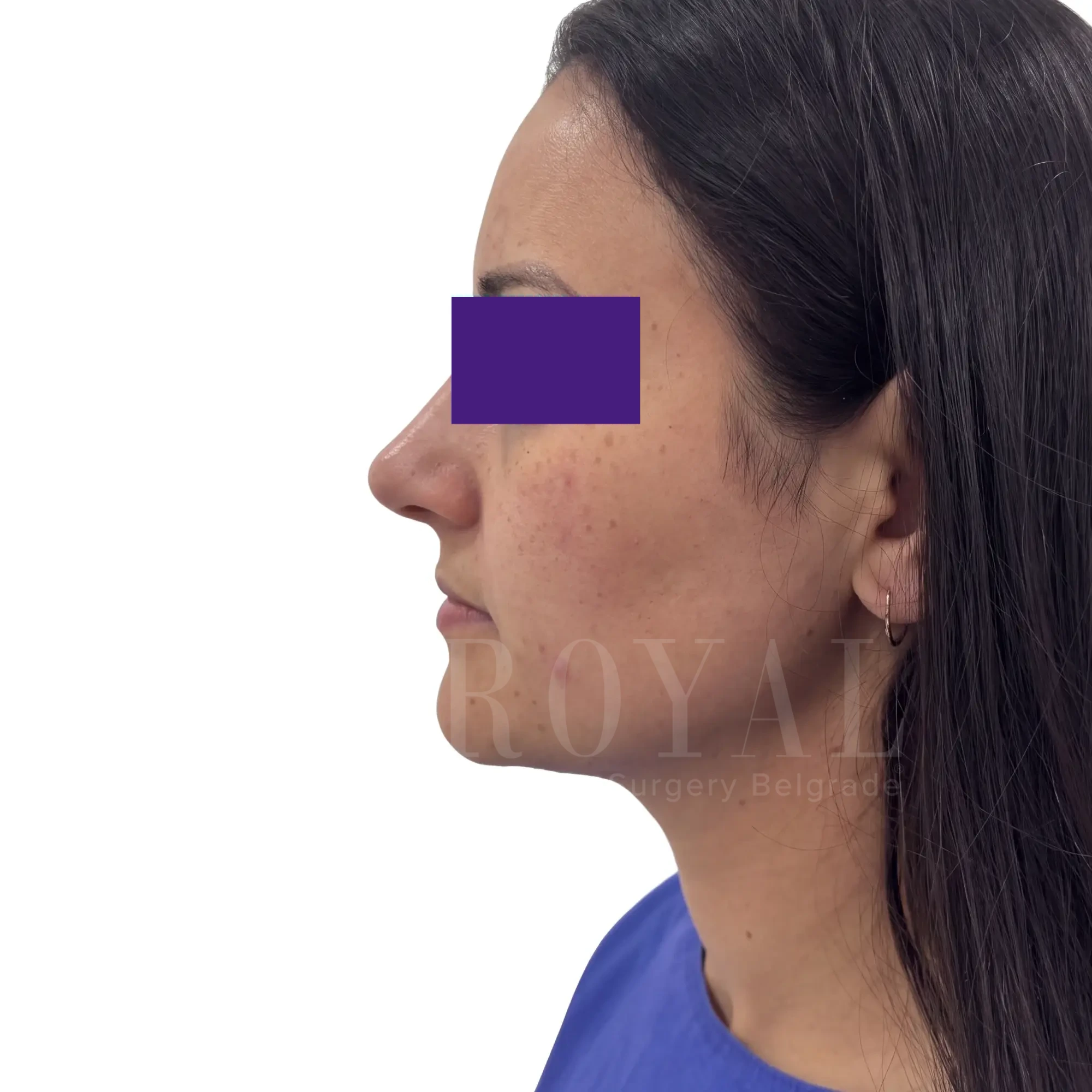 Plastic surgery | Nose surgery 20