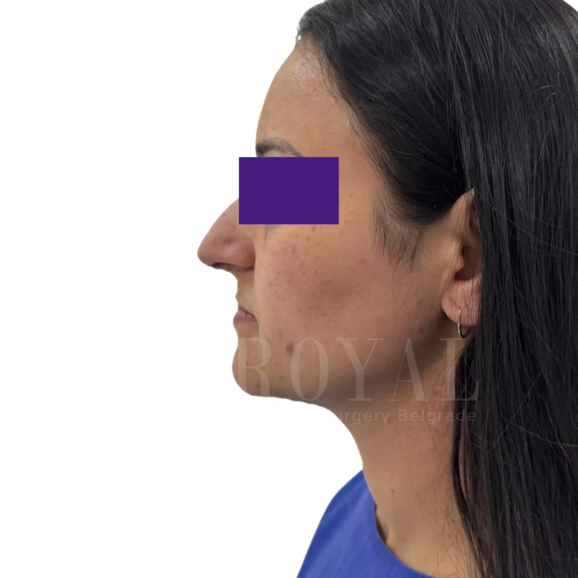 Plastic surgery | Nose surgery 20