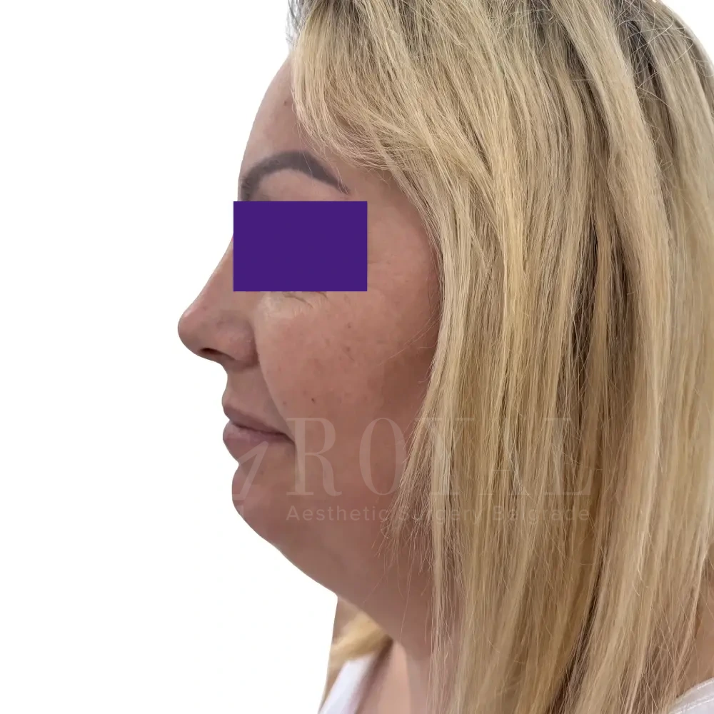 Plastic surgery | Nose surgery 12