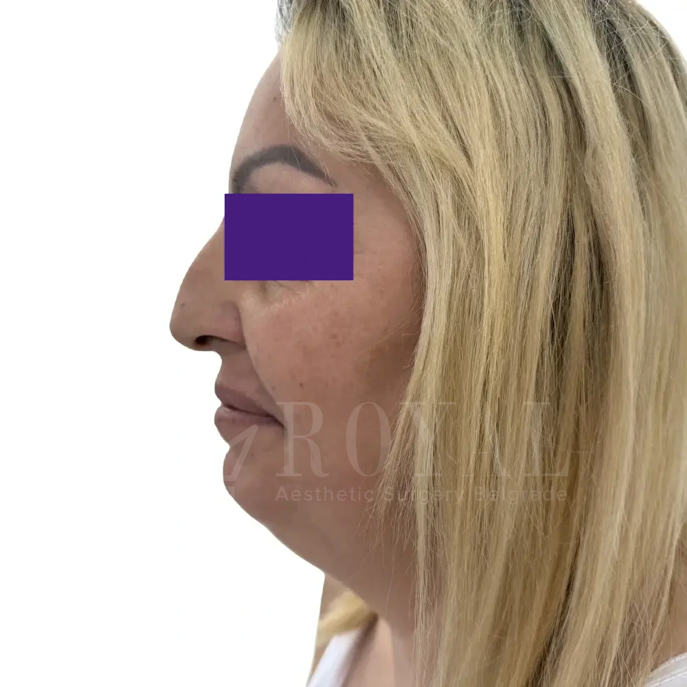 Plastic surgery | Nose surgery 12