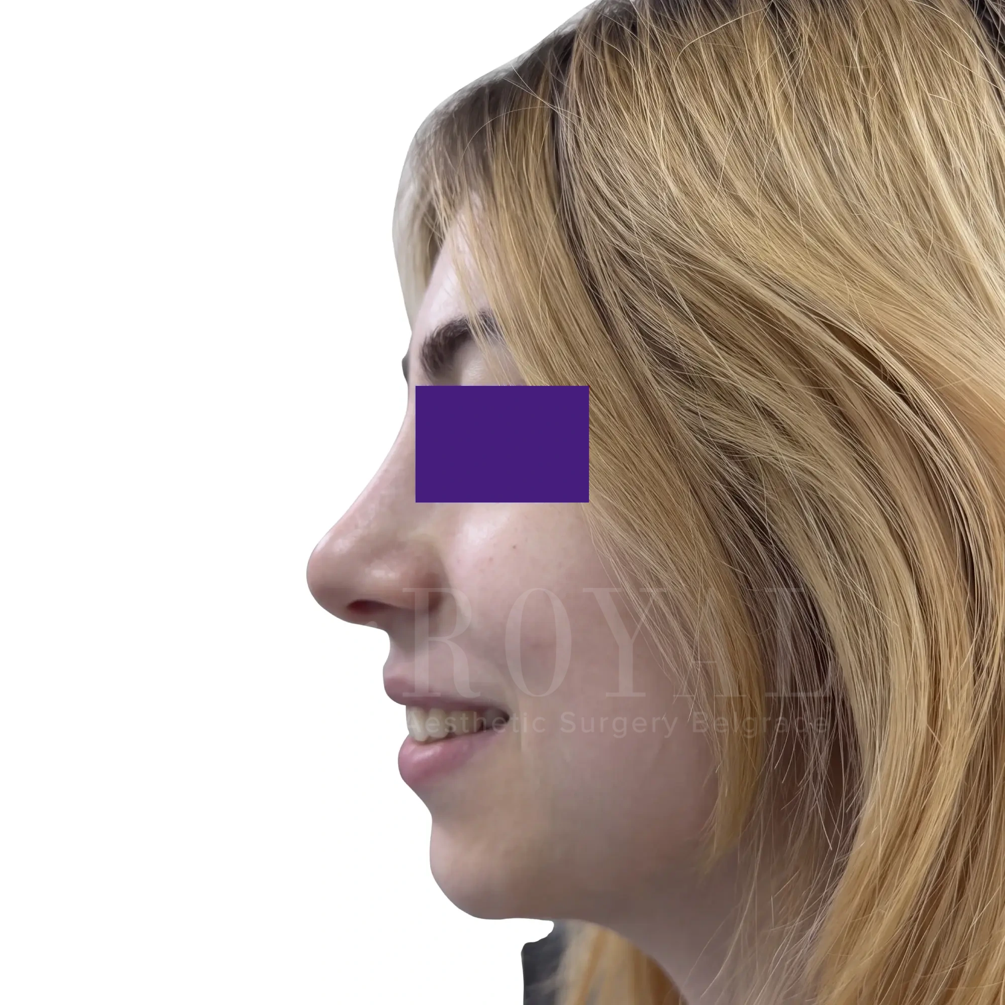 Plastic surgery | Nose surgery 15