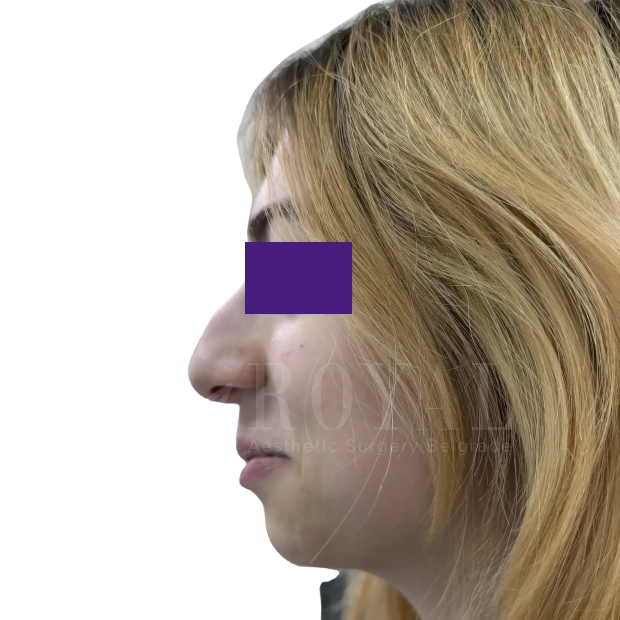 Plastic surgery | Nose surgery 15
