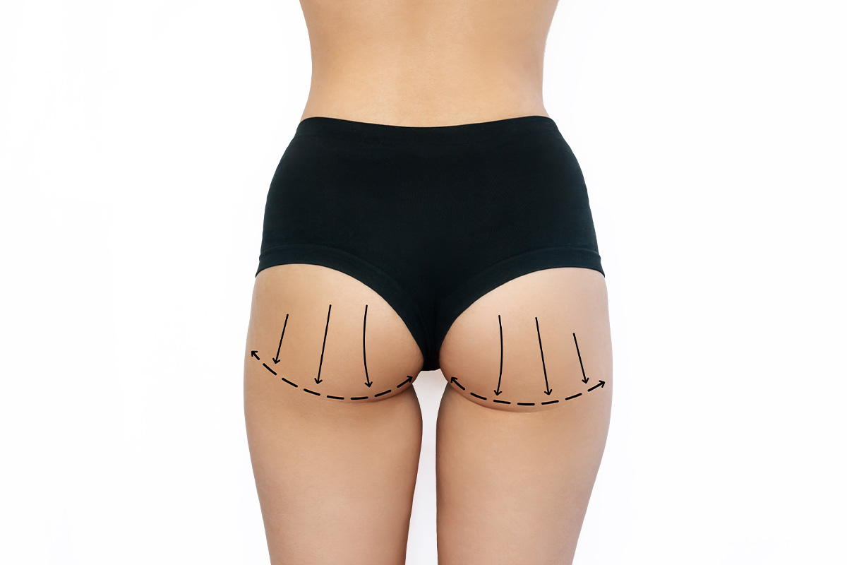 Brazilian butt lift | Brazilian butt lift