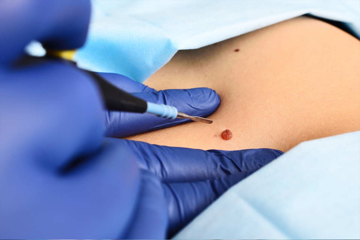 Uklanjanje hemangioma | Uklanjanje hemangioma