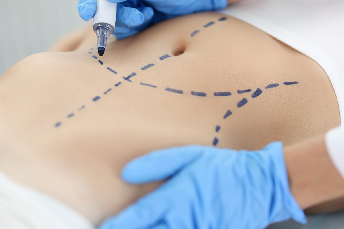 Abdominal liposuction | Abdominal liposuction