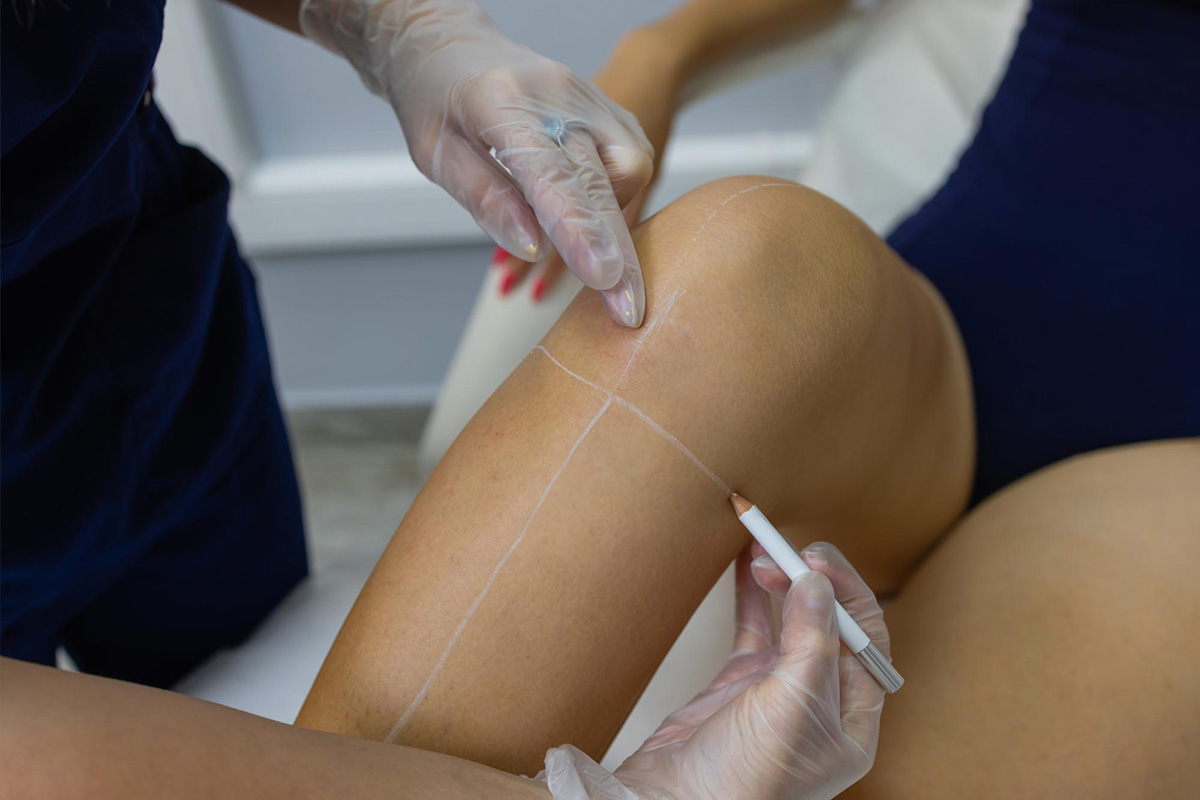 Knee liposuction | Knee liposuction