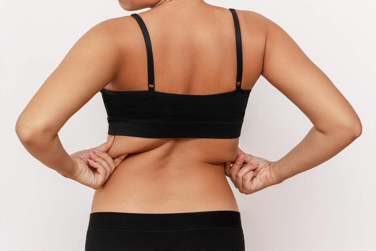 Liposuction of the back (infrascapular) | Liposuction of the back (infrascapular)