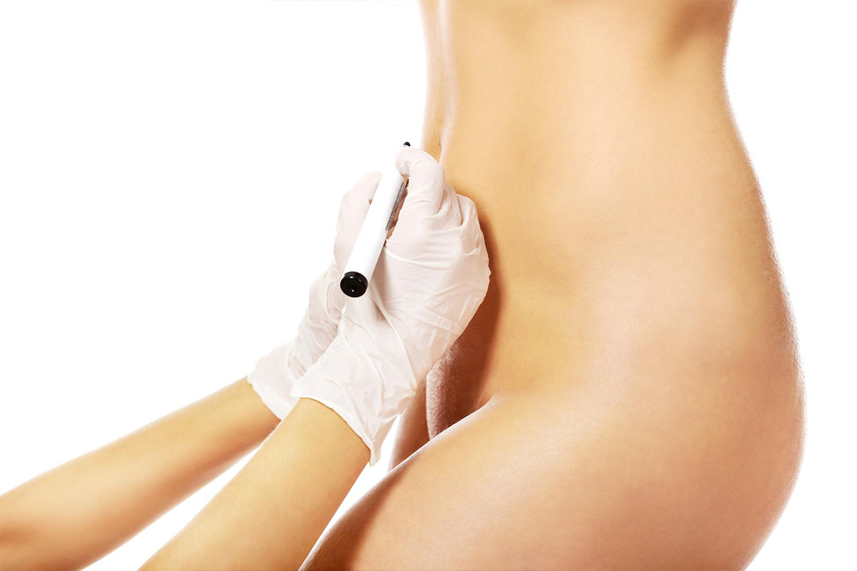 Liposuction of the pubic region | Liposuction of the pubic region