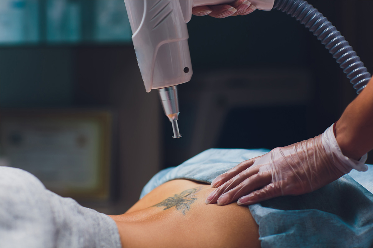 Tattoo removal | Tattoo removal