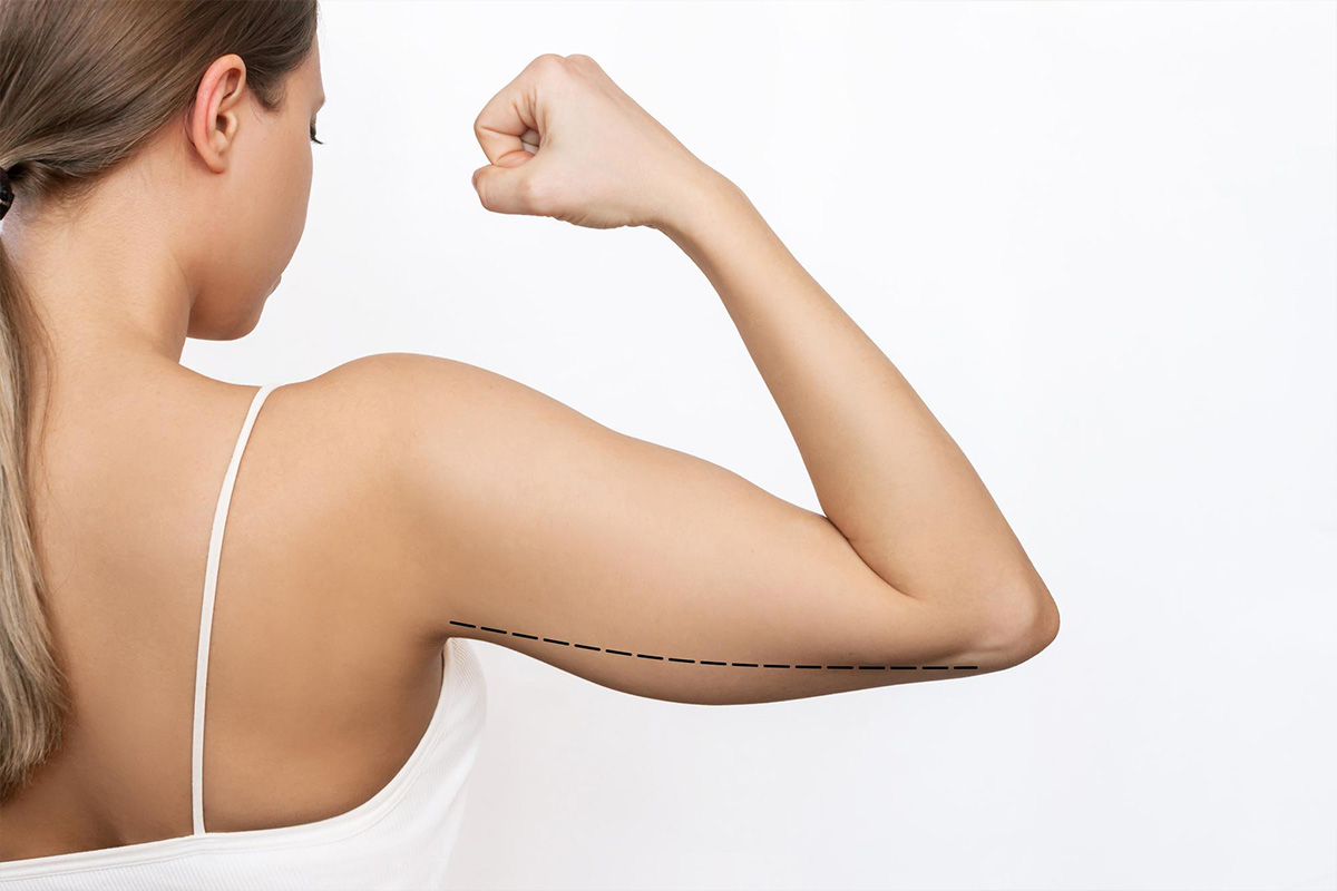 Upper arm liposuction | Upper arm liposuction