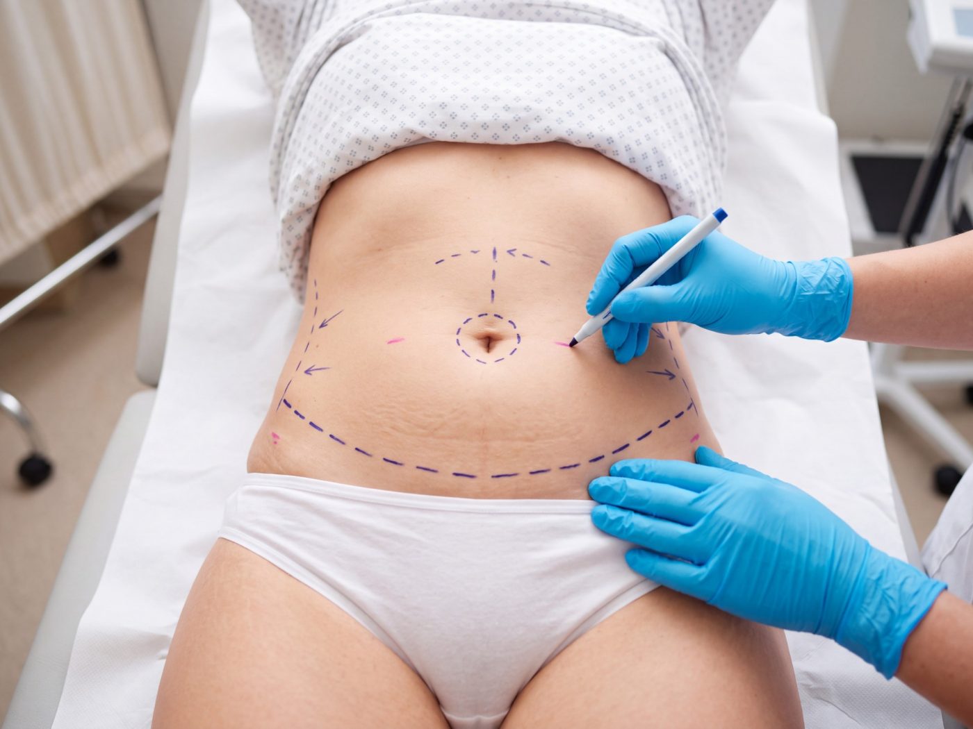 Plastic surgery | Abdominoplasty before and after