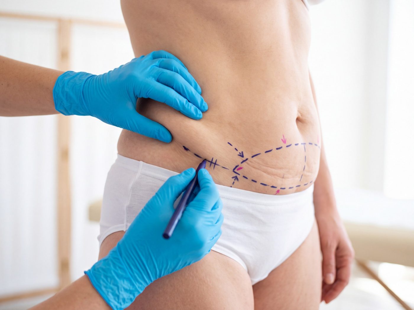Plastic surgery | Dermolipectomy before and after
