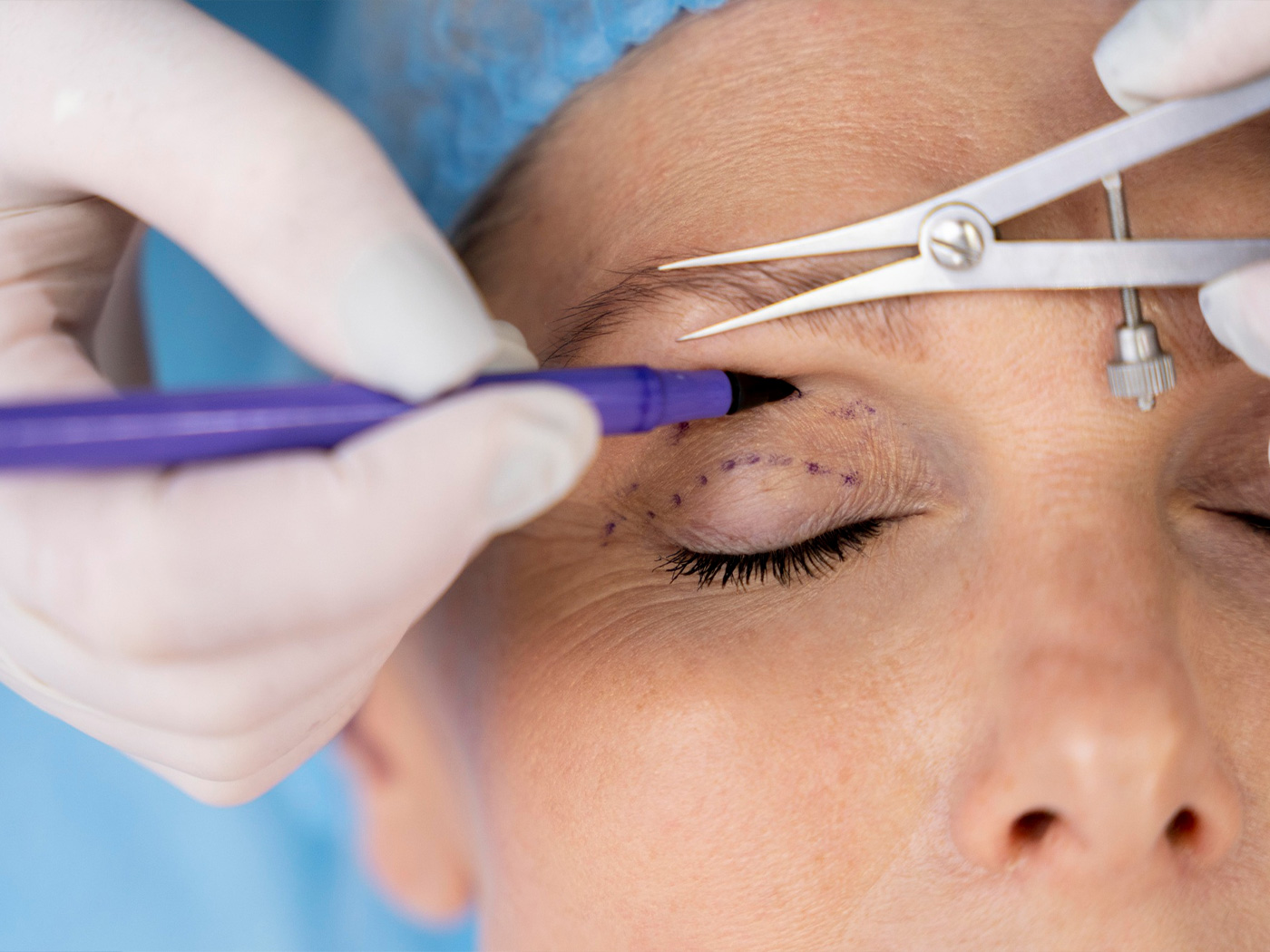 Plastic surgery | Eyelid surgery before and after