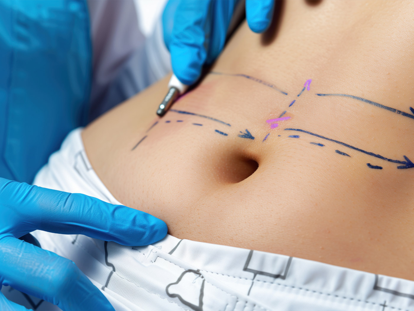 Plastic surgery | Liposuction before and after